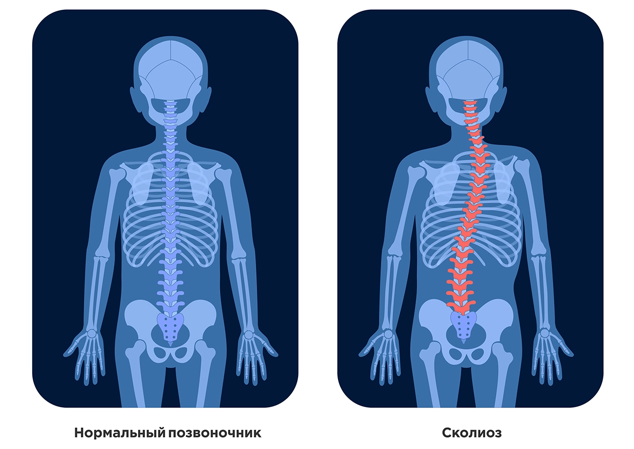 Сколиоз у детей - симптомы, степени, профилактика и методы лечения